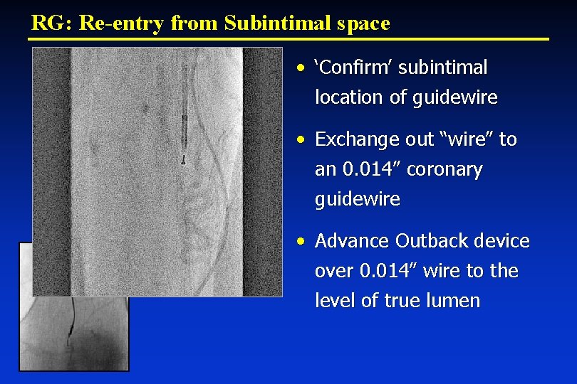 RG: Re-entry from Subintimal space • ‘Confirm’ subintimal location of guidewire • Exchange out