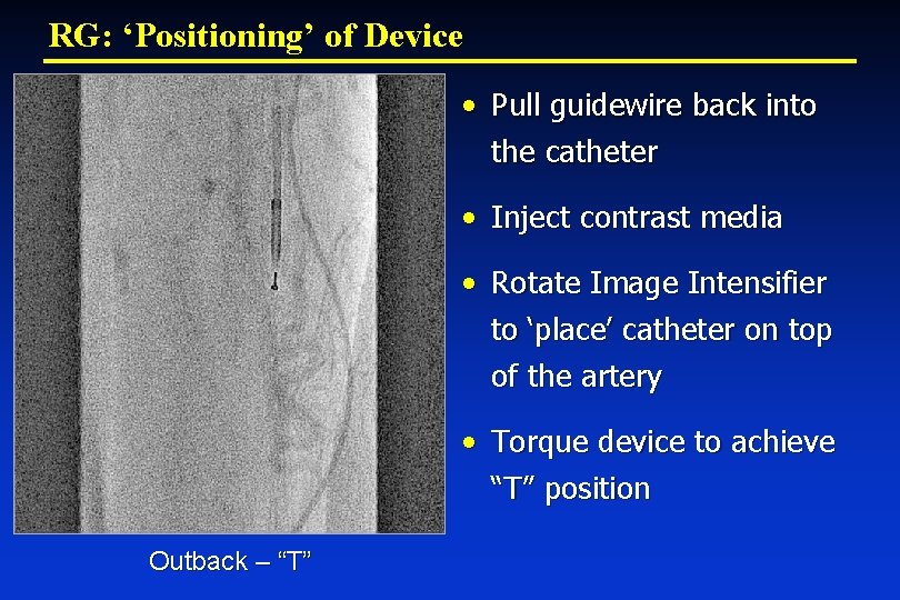 RG: ‘Positioning’ of Device • Pull guidewire back into the catheter • Inject contrast