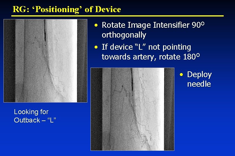 RG: ‘Positioning’ of Device • Rotate Image Intensifier 90 O orthogonally • If device