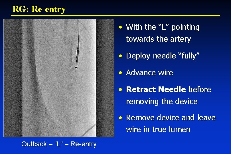RG: Re-entry • With the “L” pointing towards the artery • Deploy needle “fully”