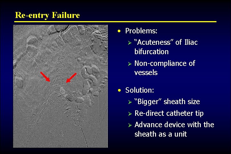 Re-entry Failure • Problems: Ø “Acuteness” of Iliac bifurcation Ø Non-compliance of vessels •