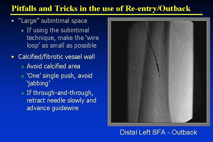 Pitfalls and Tricks in the use of Re-entry/Outback • “Large” subintimal space Ø If