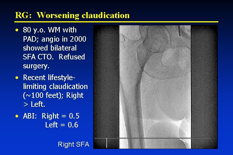 RG: Worsening claudication • 80 y. o. WM with PAD; angio in 2000 showed