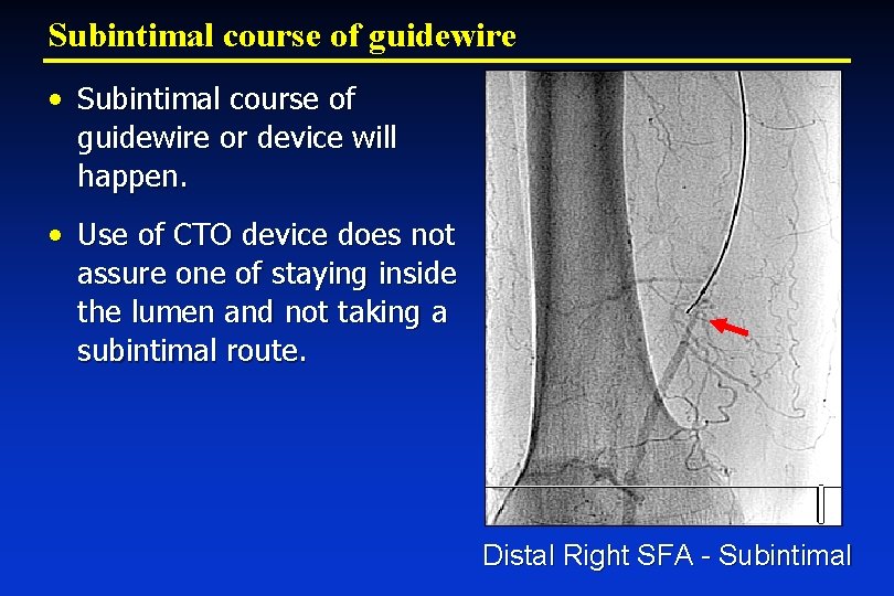 Subintimal course of guidewire • Subintimal course of guidewire or device will happen. •