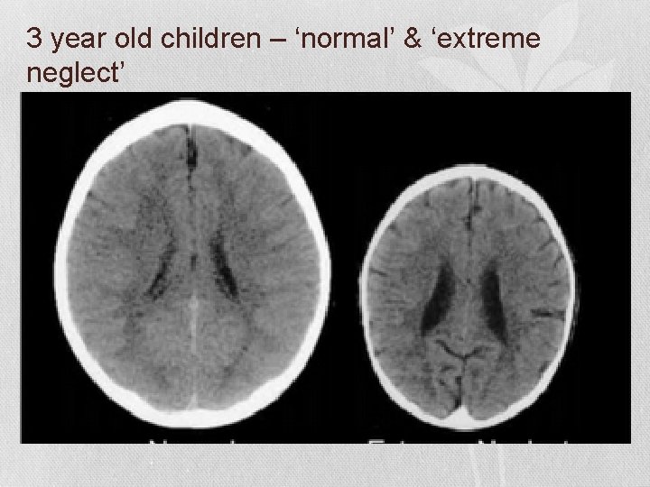 3 year old children – ‘normal’ & ‘extreme neglect’ 