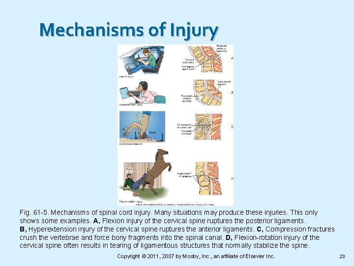 Mechanisms of Injury Fig. 61 -5. Mechanisms of spinal cord injury. Many situations may