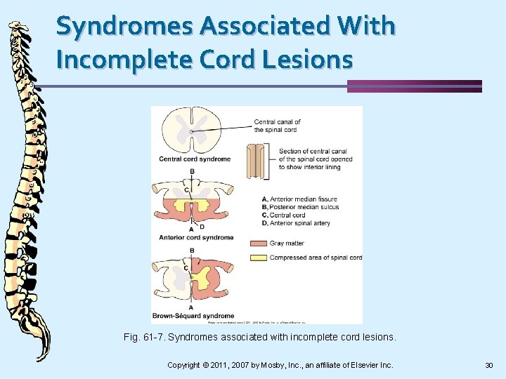 Syndromes Associated With Incomplete Cord Lesions Fig. 61 -7. Syndromes associated with incomplete cord