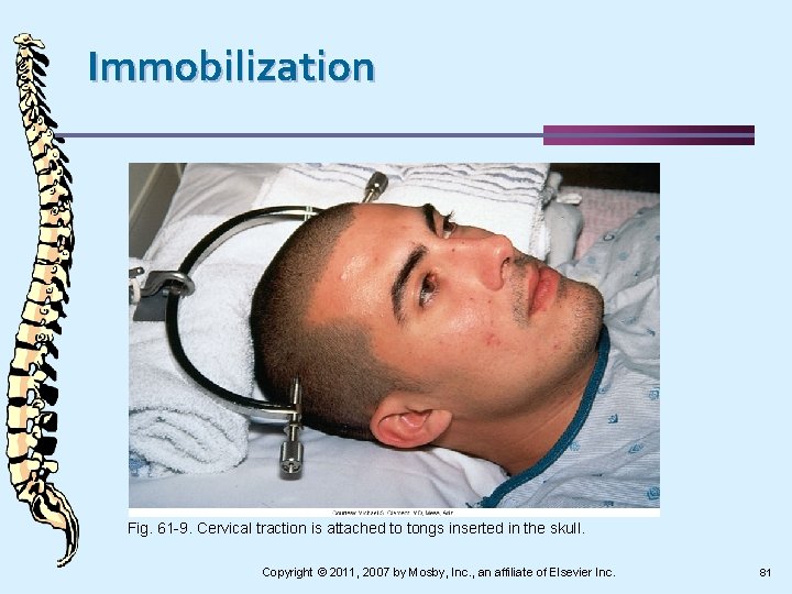 Immobilization Fig. 61 -9. Cervical traction is attached to tongs inserted in the skull.