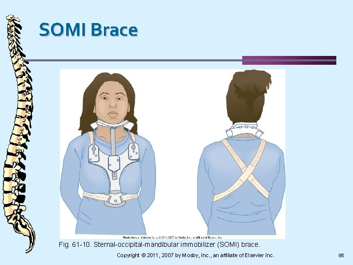 SOMI Brace Fig. 61 -10. Sternal-occipital-mandibular immobilizer (SOMI) brace. Copyright © 2011, 2007 by