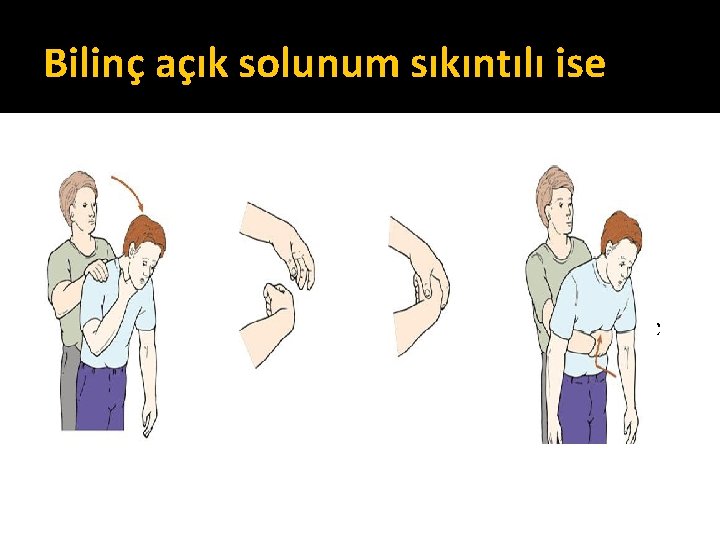 Bilinç açık solunum sıkıntılı ise Yabancı cisim aspirasyonu? ? Hastaya sorun: “Boğuluyor musunuz? ” Bilinç açık solunum sıkıntılı ise Yabancı cisim aspirasyonu? ? Hastaya sorun: “Boğuluyor musunuz? ”