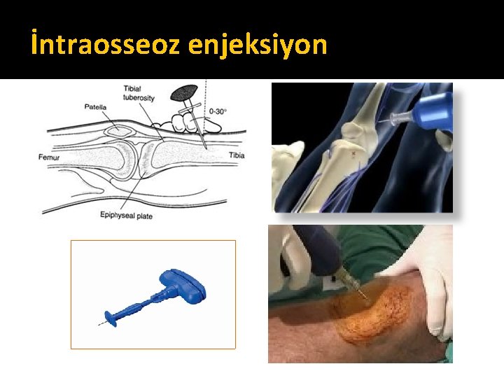 İntraosseoz enjeksiyon İntraosseoz enjeksiyon