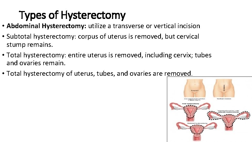 Types of Hysterectomy • Abdominal Hysterectomy: utilize a transverse or vertical incision • Subtotal