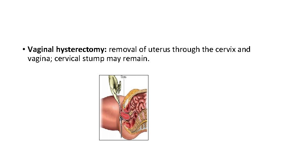  • Vaginal hysterectomy: removal of uterus through the cervix and vagina; cervical stump