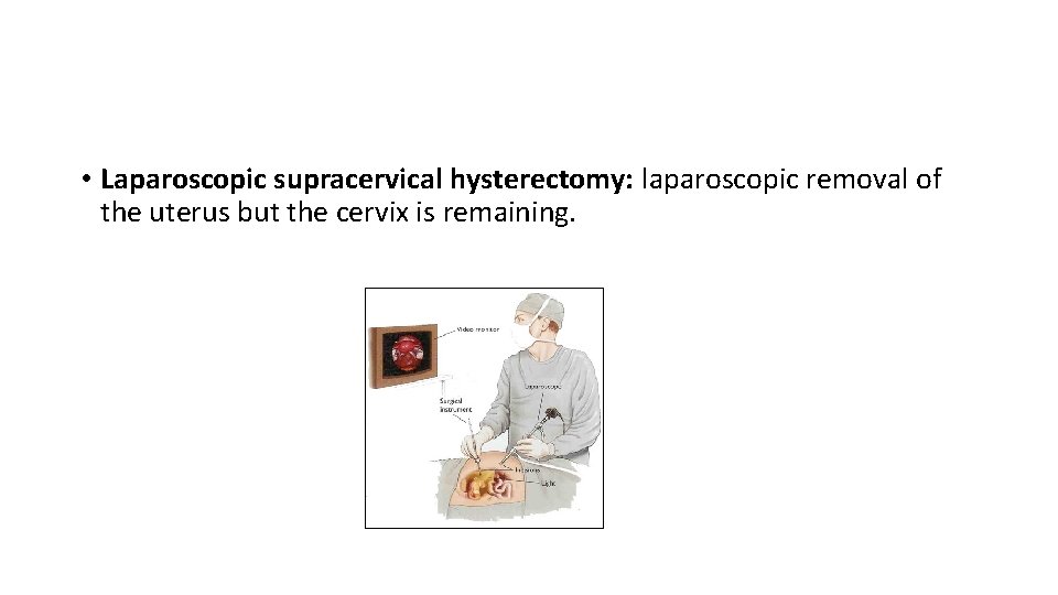  • Laparoscopic supracervical hysterectomy: laparoscopic removal of the uterus but the cervix is