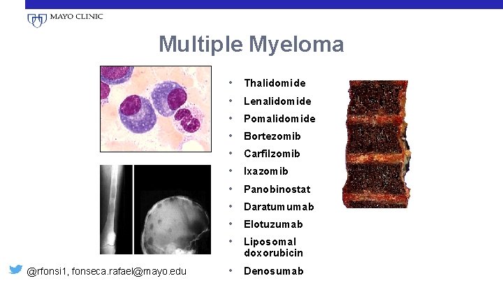Multiple Myeloma • • • @rfonsi 1, fonseca. rafael@mayo. edu Thalidomide Lenalidomide Pomalidomide Bortezomib