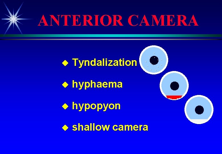 ANTERIOR CAMERA u Tyndalization u hyphaema . . . . u hypopyon u shallow