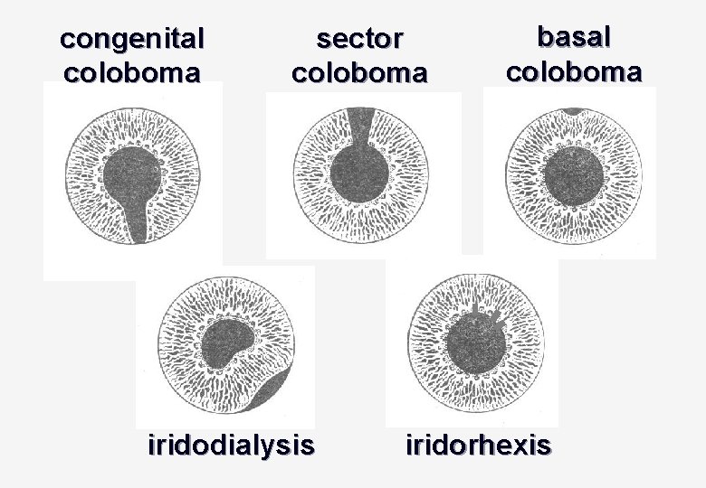 congenital coloboma sector coloboma iridodialysis basal coloboma iridorhexis 