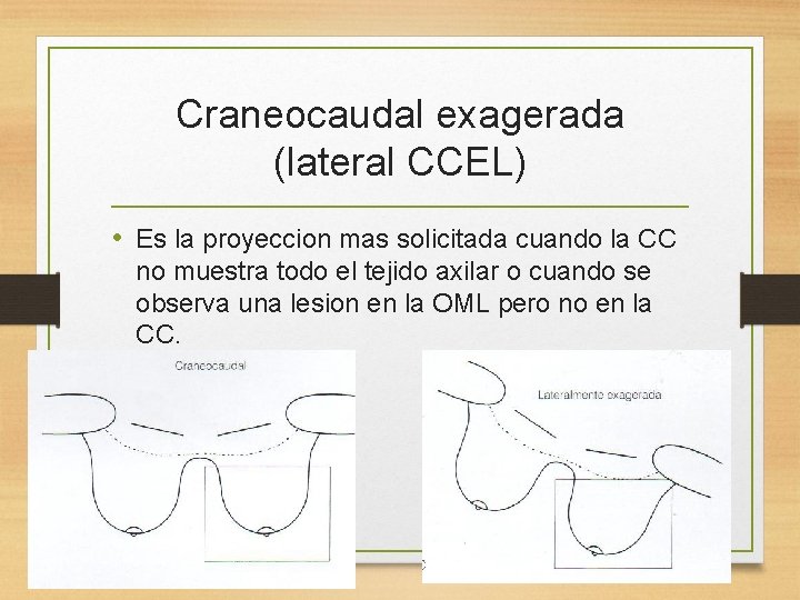 Craneocaudal exagerada (lateral CCEL) • Es la proyeccion mas solicitada cuando la CC no