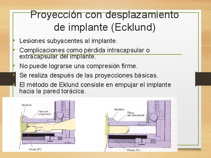 Proyección con desplazamiento de implante (Ecklund) • Lesiones subyacentes al implante. • Complicaciones como