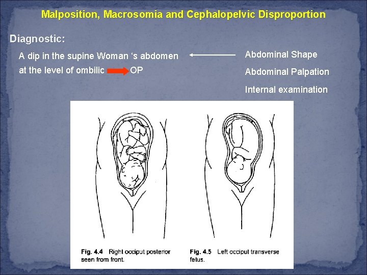 Malposition, Macrosomia and Cephalopelvic Disproportion Diagnostic: A dip in the supine Woman ‘s abdomen