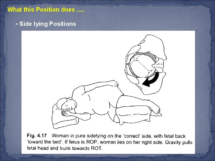 What this Position does. . . - Side lying Positions 