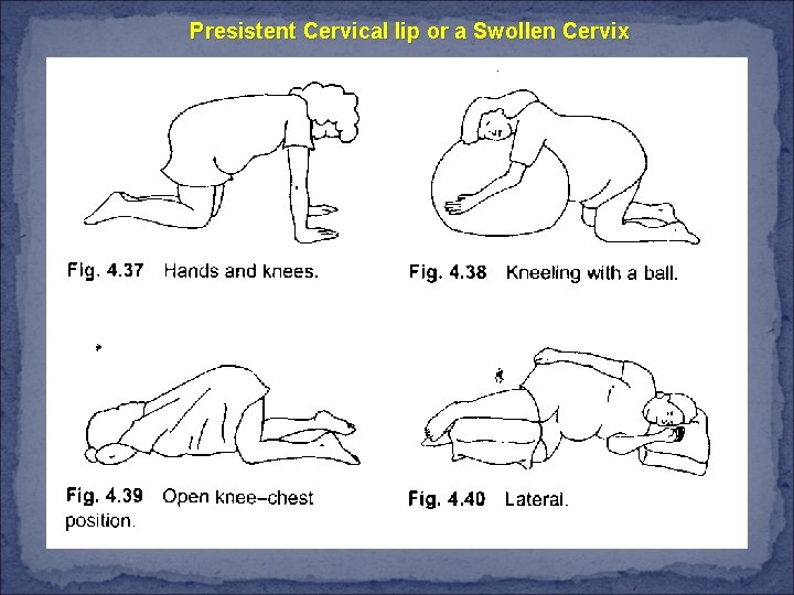 Presistent Cervical lip or a Swollen Cervix 