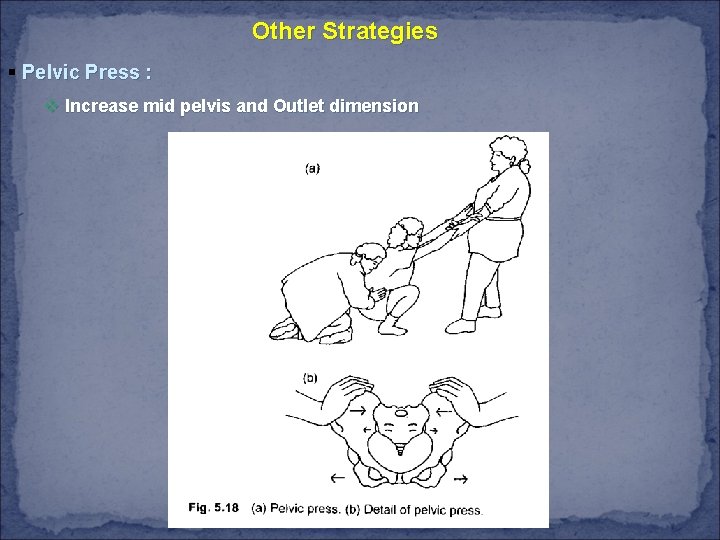 Other Strategies § Pelvic Press : v Increase mid pelvis and Outlet dimension 