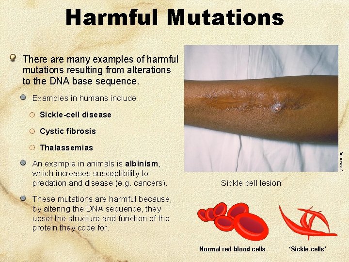 Harmful Mutations There are many examples of harmful mutations resulting from alterations to the