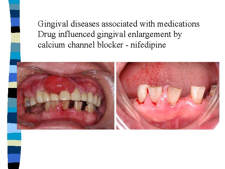 Gingival diseases associated with medications Drug influenced gingival enlargement by calcium channel blocker - Gingival diseases associated with medications Drug influenced gingival enlargement by calcium channel blocker -