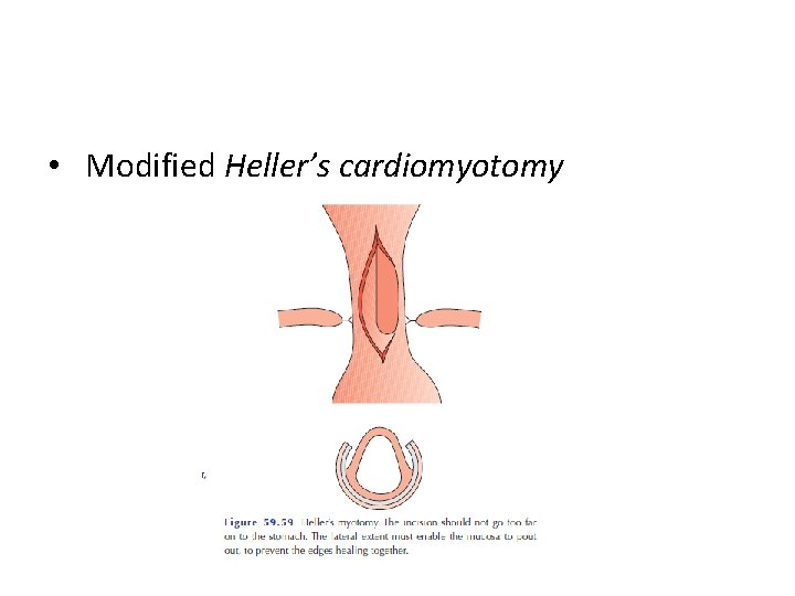  • Modified Heller’s cardiomyotomy 