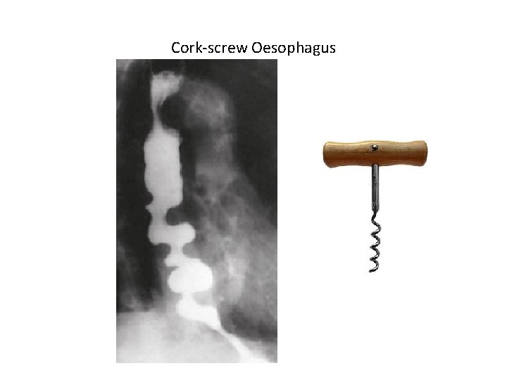 Cork-screw Oesophagus 