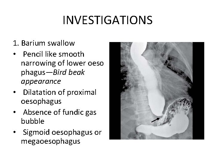 INVESTIGATIONS 1. Barium swallow • Pencil like smooth narrowing of lower oeso phagus—Bird beak