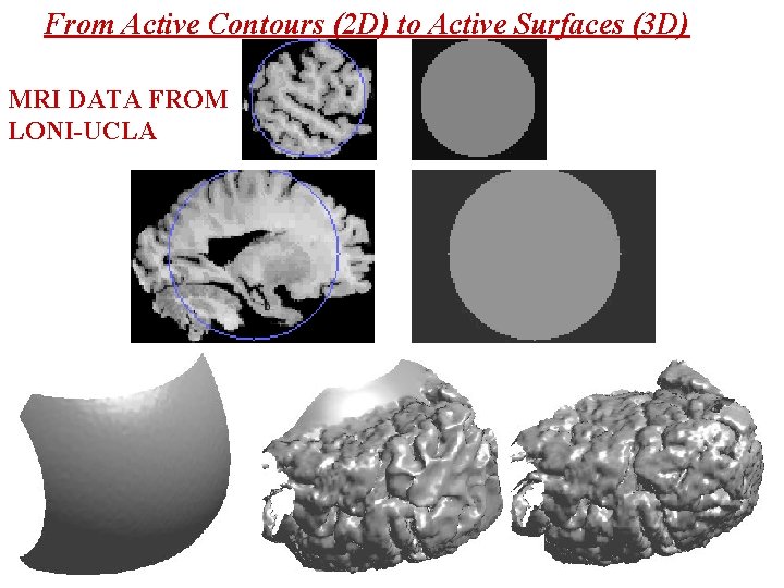 From Active Contours (2 D) to Active Surfaces (3 D) MRI DATA FROM LONI-UCLA