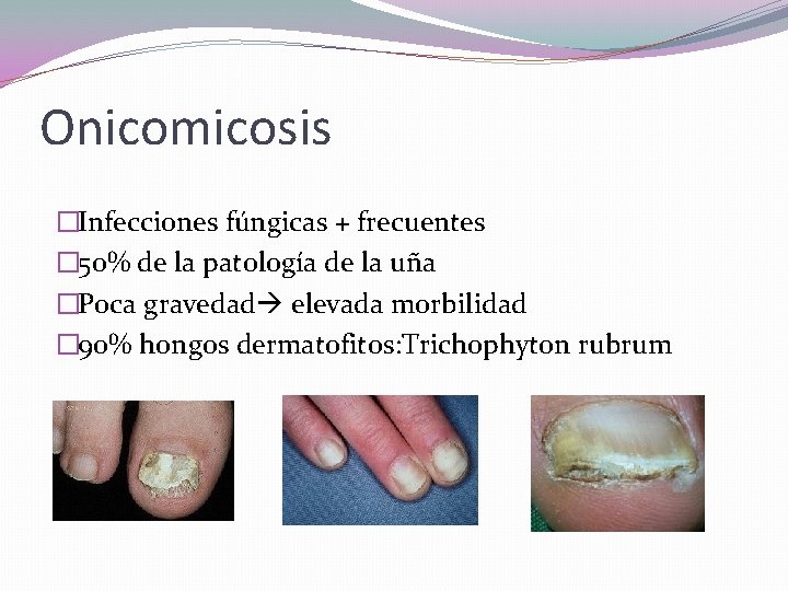 Onicomicosis �Infecciones fúngicas + frecuentes � 50% de la patología de la uña �Poca