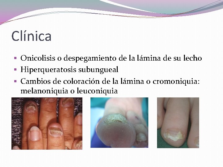 Clínica § Onicolisis o despegamiento de la lámina de su lecho § Hiperqueratosis subungueal