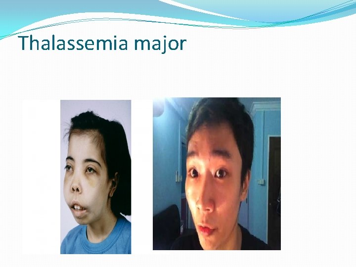 Thalassemia major 