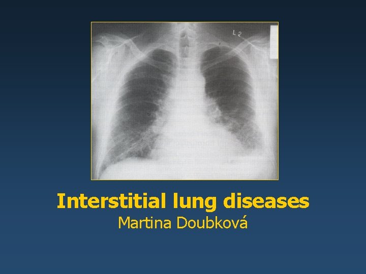 Interstitial lung diseases Martina Doubková 