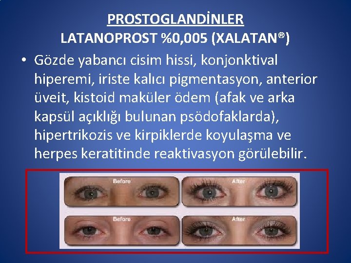 PROSTOGLANDİNLER LATANOPROST %0, 005 (XALATAN®) • Gözde yabancı cisim hissi, konjonktival hiperemi, iriste kalıcı