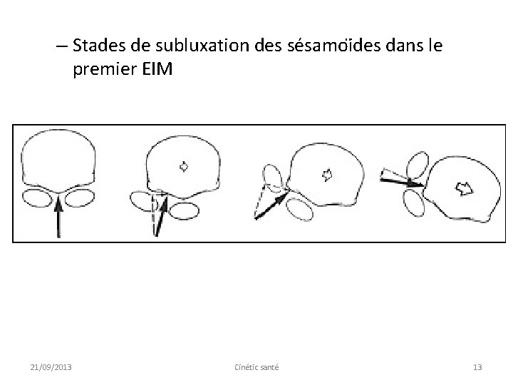 – Stades de subluxation des se samoi des dans le premier EIM 21/09/2013 Cinétic