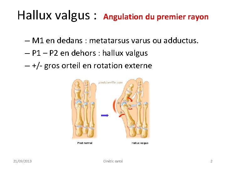 Hallux valgus : Angulation du premier rayon – M 1 en dedans : metatarsus