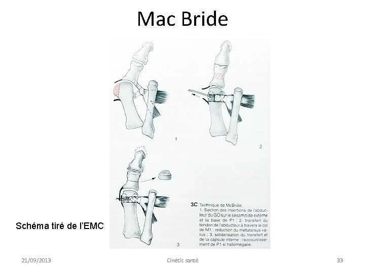 Mac Bride Schéma tiré de l’EMC 21/09/2013 Cinétic santé 33 