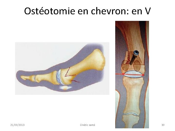 Ostéotomie en chevron: en V 21/09/2013 Cinétic santé 39 