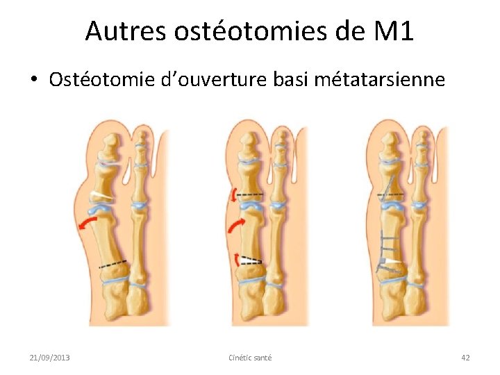 Autres ostéotomies de M 1 • Ostéotomie d’ouverture basi métatarsienne 21/09/2013 Cinétic santé 42