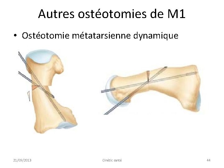 Autres ostéotomies de M 1 • Ostéotomie métatarsienne dynamique 21/09/2013 Cinétic santé 44 