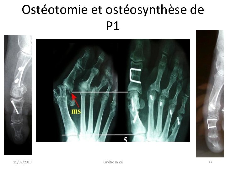 Ostéotomie et ostéosynthèse de P 1 21/09/2013 Cinétic santé 47 