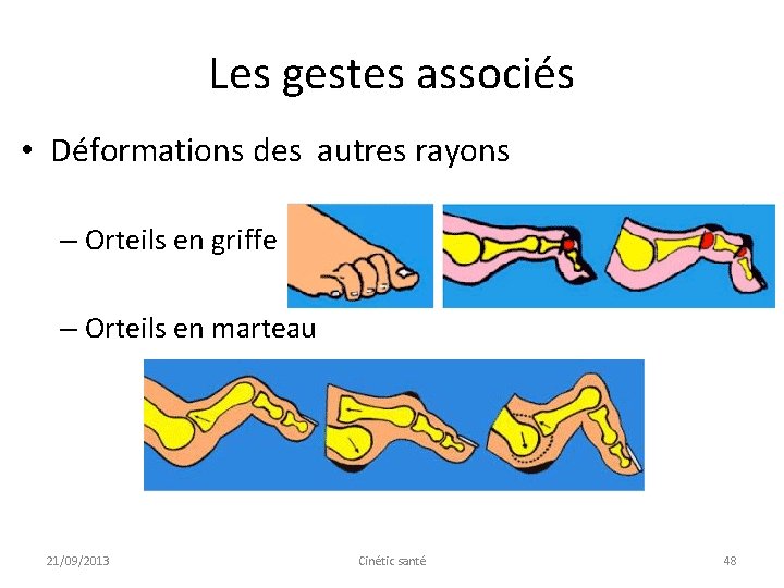 Les gestes associés • Déformations des autres rayons – Orteils en griffe – Orteils