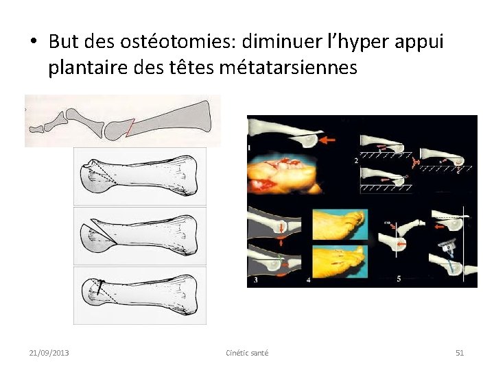  • But des ostéotomies: diminuer l’hyper appui plantaire des têtes métatarsiennes 21/09/2013 Cinétic