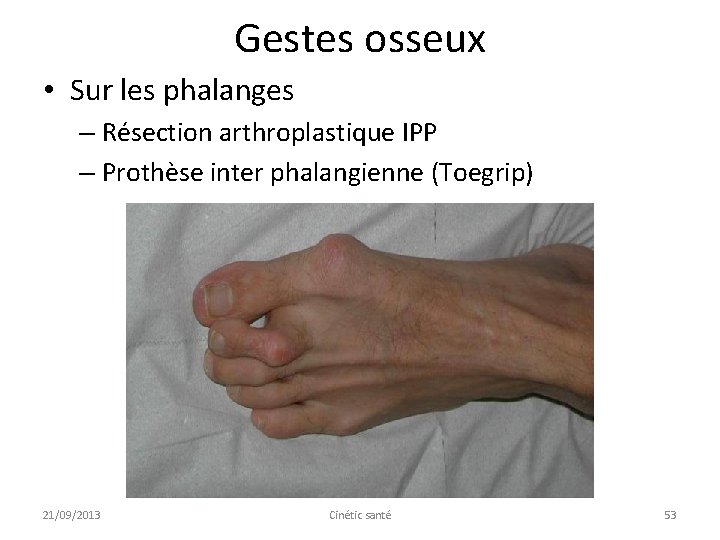 Gestes osseux • Sur les phalanges – Résection arthroplastique IPP – Prothèse inter phalangienne