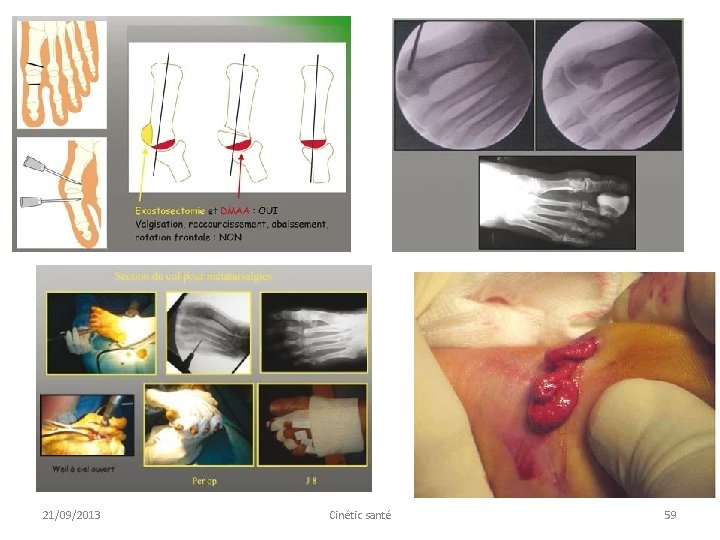 21/09/2013 Cinétic santé 59 