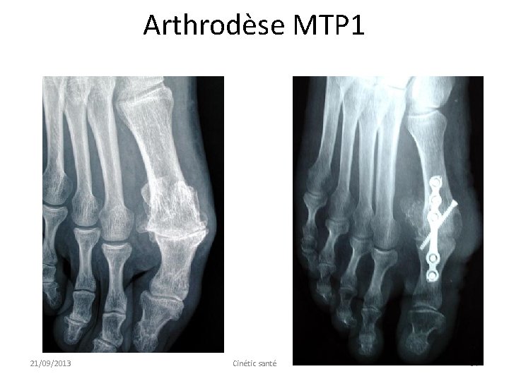 Arthrodèse MTP 1 21/09/2013 Cinétic santé 64 